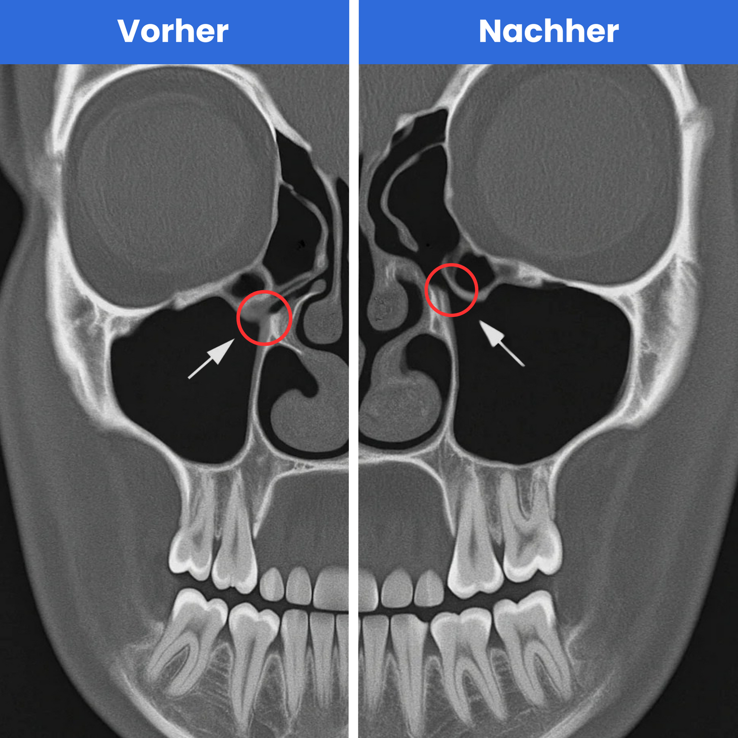 Röntgenaufnahme eines Schädels. Links (vorher) verengte Nebenhöhlen. Rechts (nachher) normale Nebenhöhlen. Die Verengung deutet auf eine Entzündung hin.